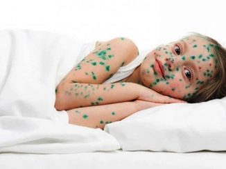 bệnh thủy đậu khi nào thì hết lây