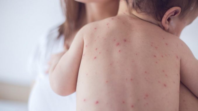 benh-soi-co-lay-khong Giải đáp thắc mắc: Bệnh sởi có lây không?