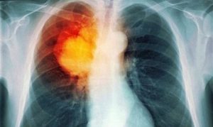 Bệnh lao phổi có chữa được không?