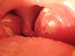 Nguyên nhân viêm amidan đáy lưỡi quá phát là gì